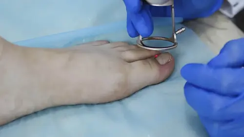 ingegroeide teennagel verwijderen